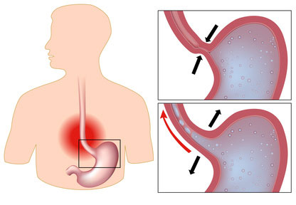 cause reflusso gastrico